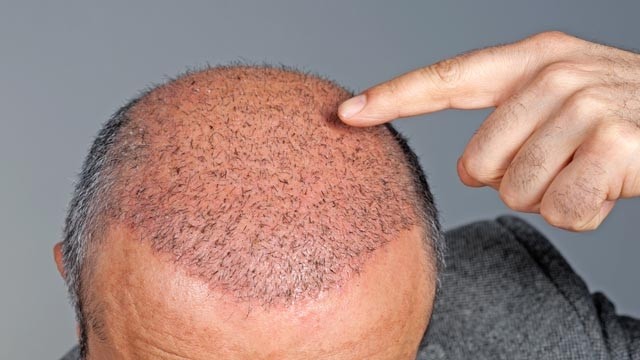 كيف تتم زراعة الشعر