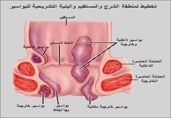 أعراض البواسير عند النساء